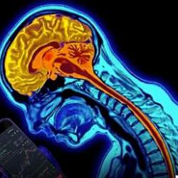 MRI / BNB