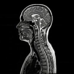 MRI / BNB